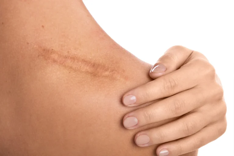 Hand near scar on person's shoulder